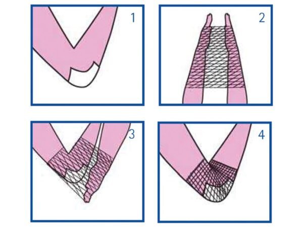 ELASTIC TUBULAR NETTING 3 for hand, elbow and arm - Image 2